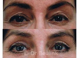 Eyelid Surgery Blepharoplasty Auckland Christchurch NZ