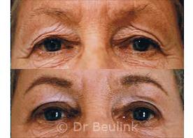 Eyelid surgery deals auckland