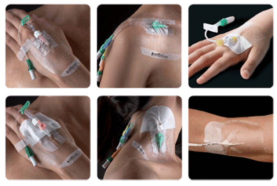 Opsite IV3000 Catheter Dressing 10cm x 14cm image 2