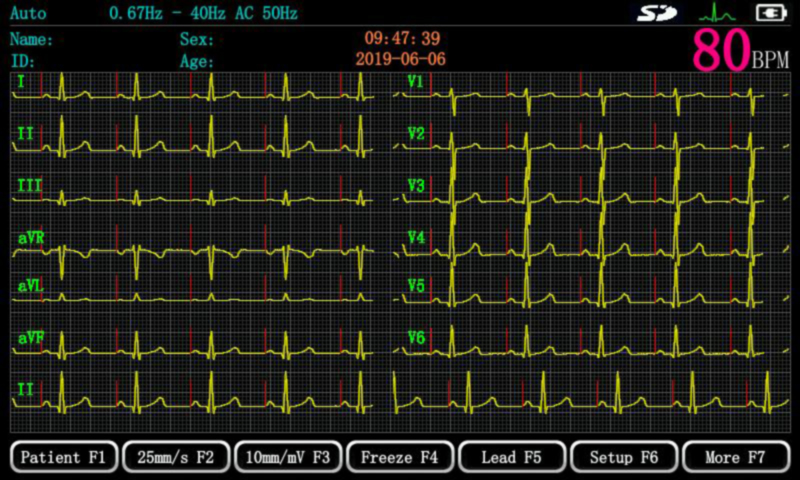 ECGMAC 3-channel ECG with 7inch display and Thermal Printer image 1