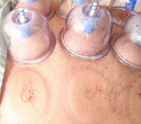 Suction Cups in Use