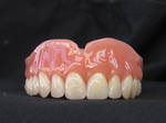 Full upper denture