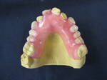 Valplast Denture