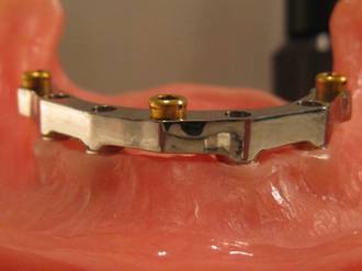 Implant Over Denture Bar