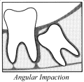 angular impact