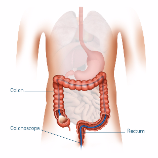 5039 GC Medical Illustrations 1080x1080px Colonoscopy-648