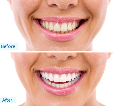 before and after home whitening-731
