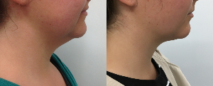 fat neck liposuction Auckland Christchurch NZ