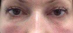 dark under eye circles treatment 2 after 250