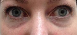 dark under eye circles treatment 3 before 250