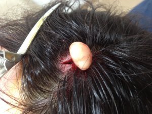 infected sebaceous cyst in scalp