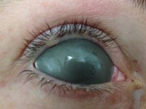laser mole removal eyelid
