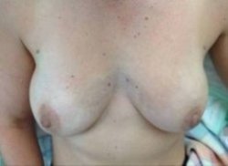 macrolane injection breast enlargement after 264 250 1
