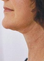neck liposuction thread lift Auckland Christchurch NZ