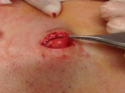 sebaceous cyst removal 3 Auckland Christchurch