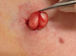 sebaceous cyst removal 4 Auckland Christchurch