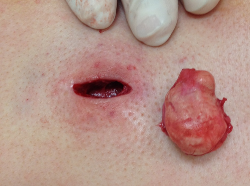 sebaceous cyst removal 5 Auckland Christchurch