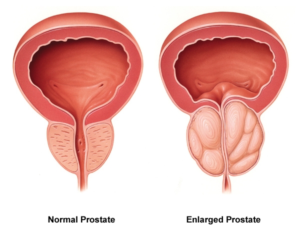 Normal-vs-enlarged-prostate