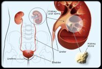 kidney stone common cause 1