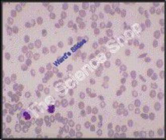 Sickle Cell Anemia (sm) Human peripheral blood Bizarre and crescent forms of RB(cs) GS