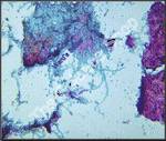 Lichen Mycobiont (wm) Teased thallus shows algae cel(ls) and fungi hyphae