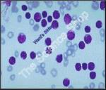 Acute Lymphatic Leukemia human SM Abnormal lymphocytes with cleaved or blastic nuclei GS