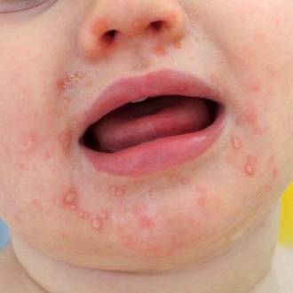 Quick guide to hand foot & mouth disease