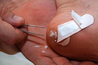 Removing splinters from kids skin