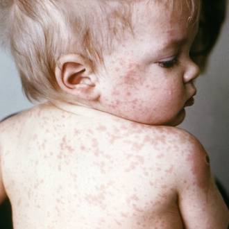 How to recognise measles in babies & kids