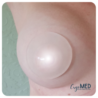 Cryomed - Eyes and breast - 1 pair (10 uses)