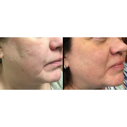Skin Classic - easily remove skin irregularities in one treatment image 6