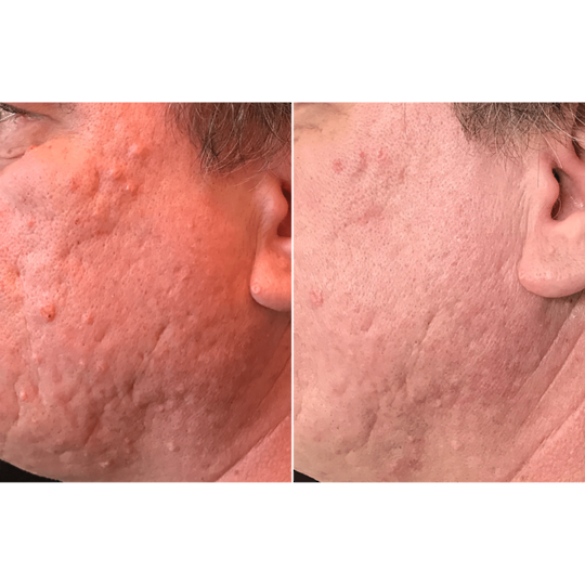 Skin Classic Device - Remove skin irregularities in one treatment image 8