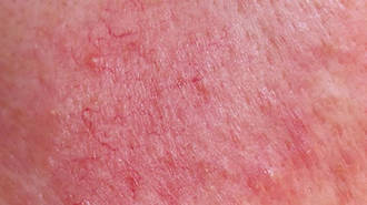 Rosacea: Triggers and subtype classification image 0