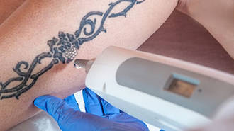 Module 1: Laser Tattoo & Benign Pigmented Blemishes Removal image 0