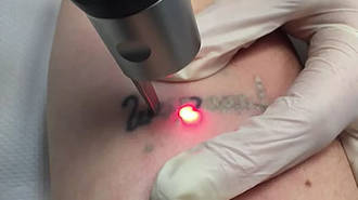 Module 2: Laser Tattoo & Benign Pigmented Blemishes Removal image 0